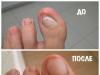 Грибок між пальцями ніг - симптоми, причини, фото та лікування